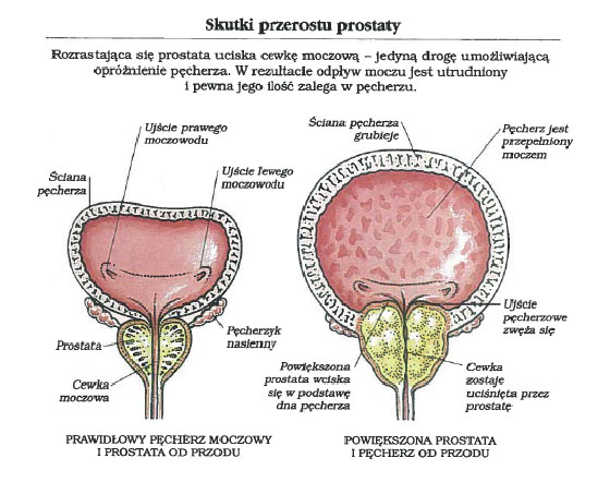 skutki-przerostu-prostaty